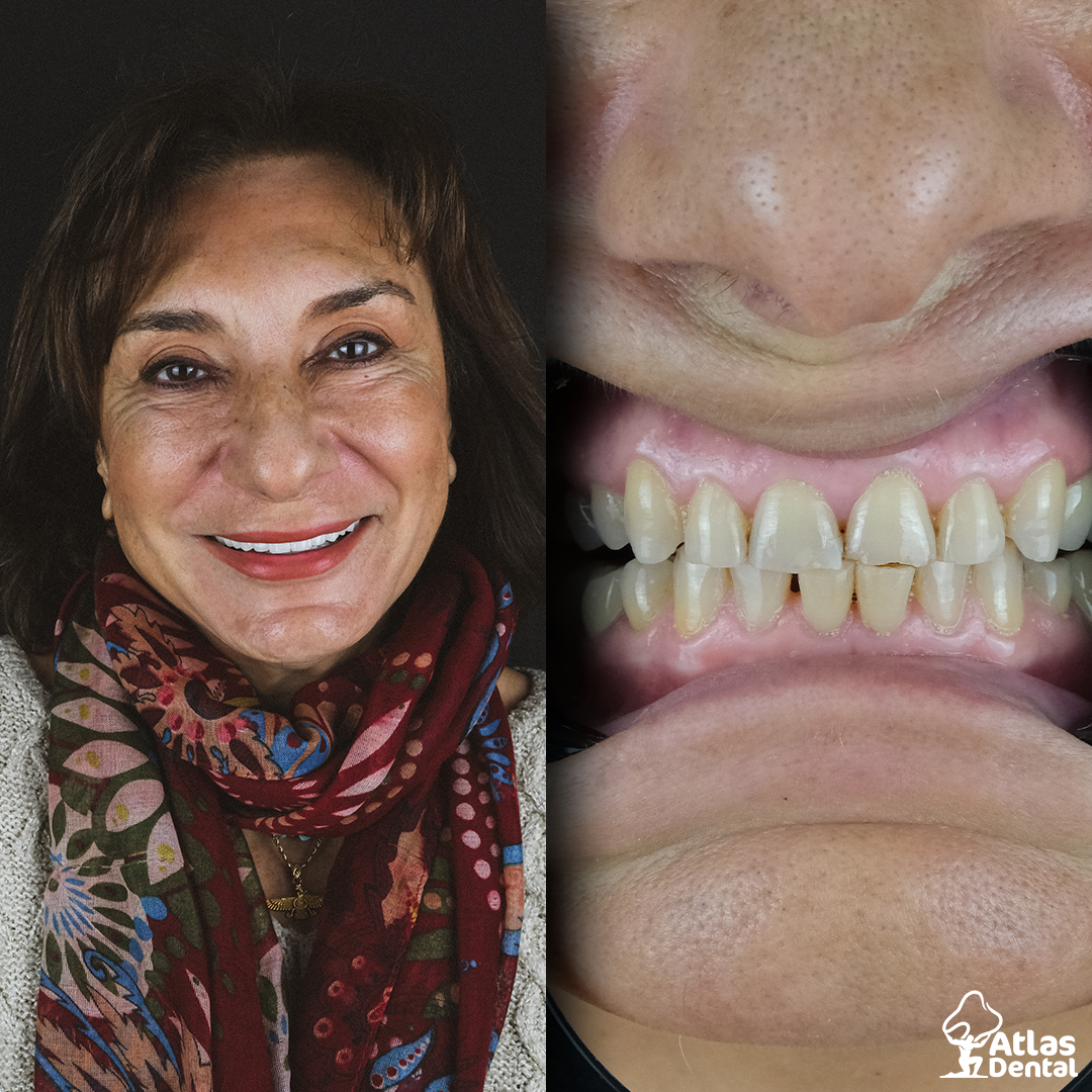 Orthodontics Atlasdentalturkey