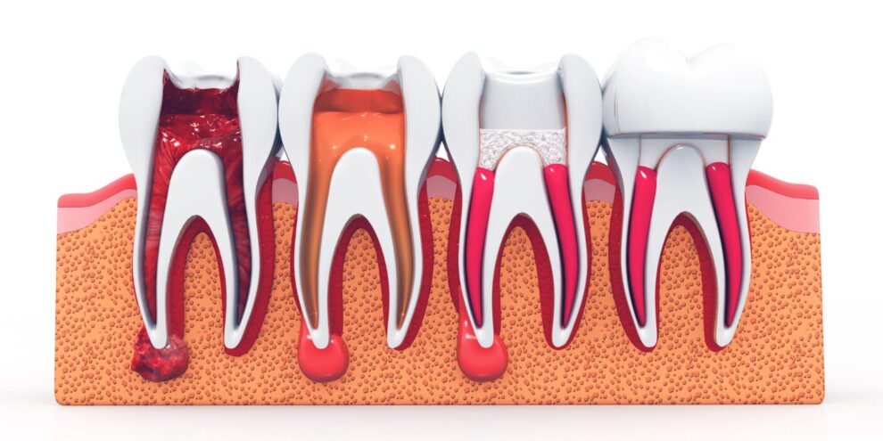 root-canal-treatment-in-turkey