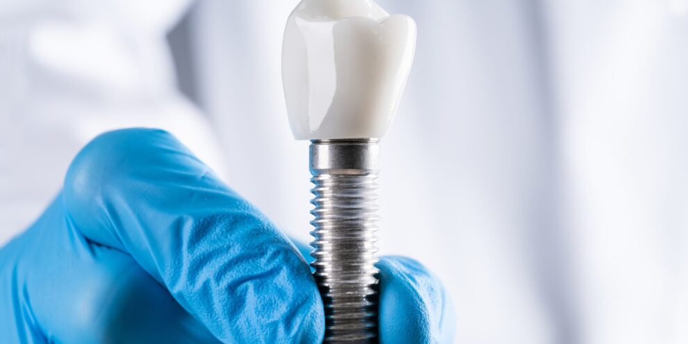 full-mouth-implant-in-turkey