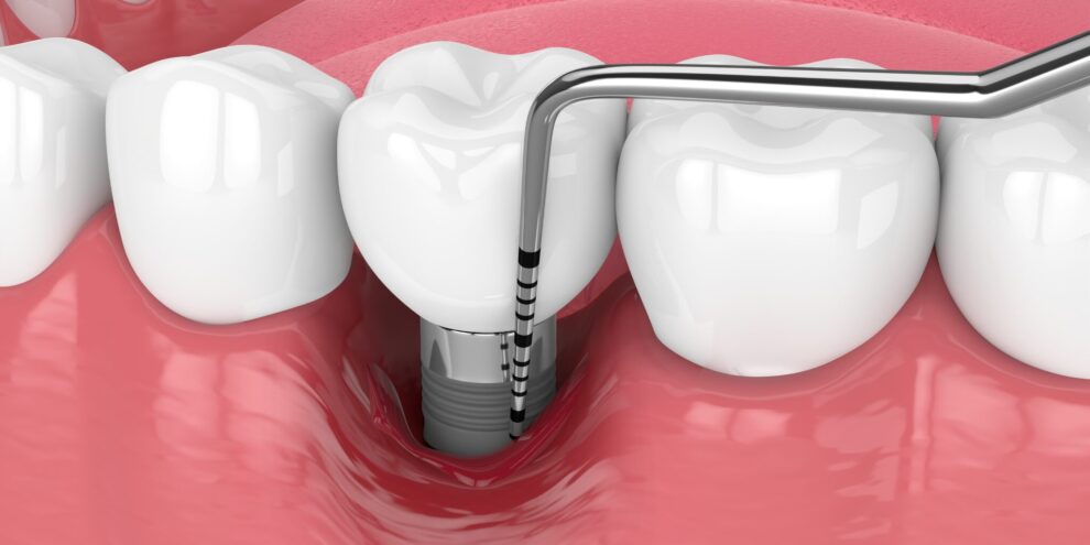 post-implant-healing-process