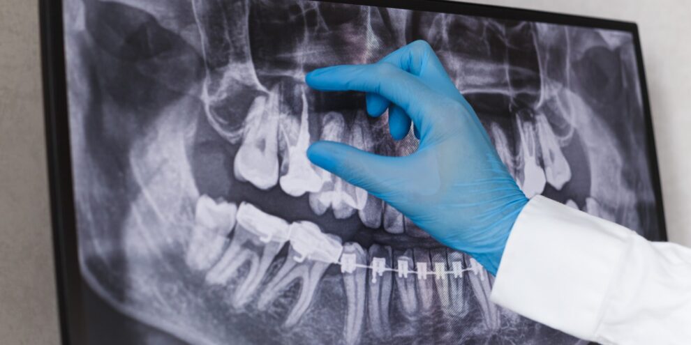 root-canal-or-tooth-extraction