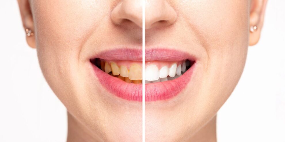 how-to-clean-tartar-off-teeth